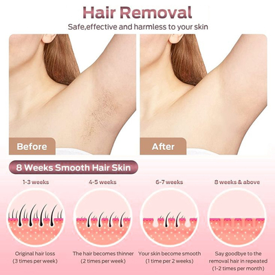 2000W Diode Laser Hair Removal Device 4 panjang gelombang 808nm 755nm 940nm 1064nm