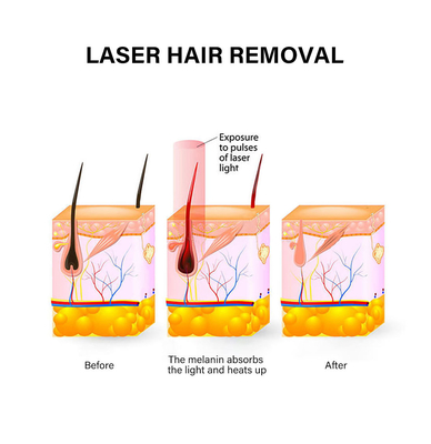 Perangkat Penghilang Rambut Laser Portable 810nm Mesin Penghilang Rambut Permanen Untuk Wanita