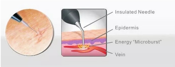 Salun kecantikan Mesin Laser Dioda 980nm Untuk Penghilang Nyeri / Pengobatan Vaskular