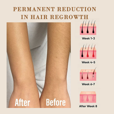 Weifang KM IPL 755 808 1064nm Diode Laser Hair Removal Machine dengan penargetan yang tepat