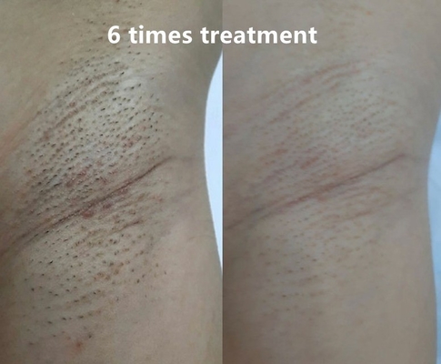 4 panjang gelombang Diode Laser Hair Removal Machine 808nm/755 808nm 1064nm Dengan manual pengguna