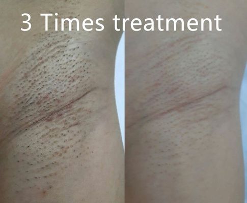 Perangkat Penghilang Rambut Laser Dioda Multi Fungsi yang Mendukung Lebar Pulsa Berbeda untuk Pengurangan Rambut Permanen yang Disesuaikan