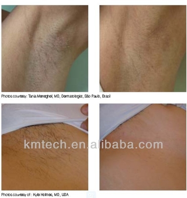 Klinik Profesional Mesin Laser Hair Removal Diode 3 gelombang KM960D