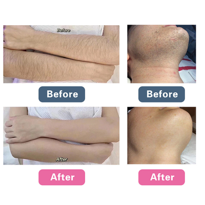 Picosecond Laser Mesin Peremajaan Wajah, Q Switched Mesin Penghapusan Tato