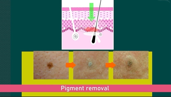 755nm Picosecond Laser Machine Untuk Penghapusan Rambut / Penghapusan Tato Bahasa Inggris Pilihan