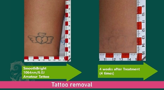 1064nm Q Switched Nd Yag Laser Picosecond Mesin Penghapusan Tato Gaya Stasioner