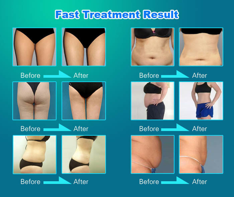 OEM / ODM Vela Slim Mesin Putih Profesional Mesin Body Contouring