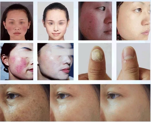 50W 980 Nm Diode Laser Spider Vein Removal Machine Untuk Solusi Pengobatan Pembuluh Darah