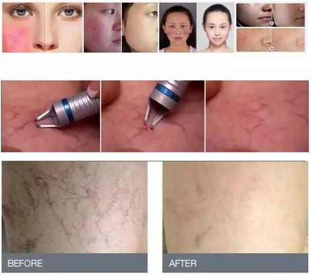 Peremajaan Kulit Mesin Laser Dioda 980nm Mesin Penghapusan Vein Laba-laba Laser Portable