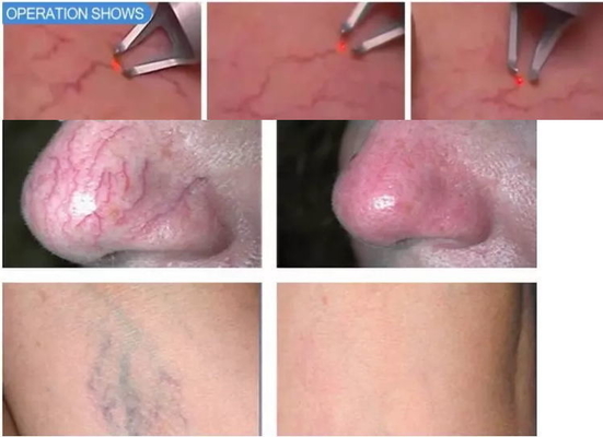 Peremajaan Kulit Mesin Laser Dioda 980nm Mesin Penghapusan Vein Laba-laba Laser Portable
