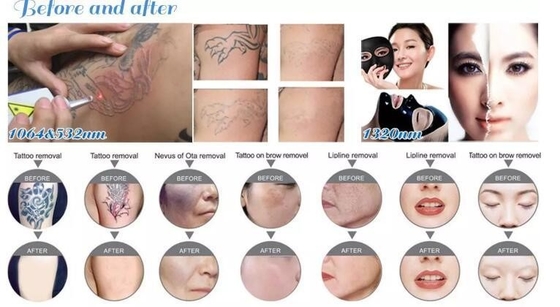 Mesin Penghapusan Tato Laser Nd YAG Portable 1064nm 532nm 1320nm Panjang Gelombang
