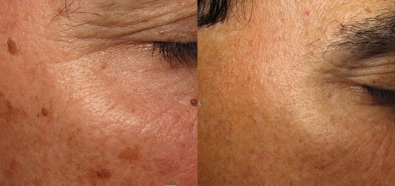 Rumah Nd YAG Mesin Kecantikan Laser Medis Untuk Kehilangan Berat Badan / Peningkatan Kulit