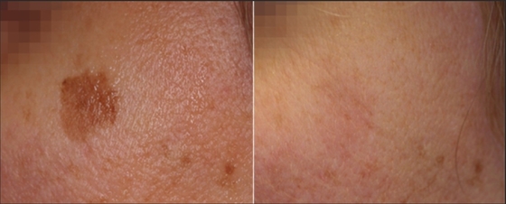 Rumah Nd YAG Mesin Kecantikan Laser Medis Untuk Kehilangan Berat Badan / Peningkatan Kulit
