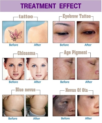 Long Pulse Nd YAG Laser Hair Removal Machine Portable Untuk Komersial