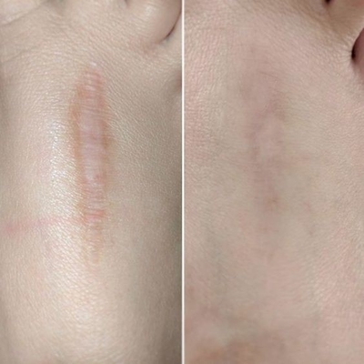 40W 60W Fractional CO2 Laser Machine Untuk Penghapusan Kerutan Stretch Mark Scar Removal Tightening