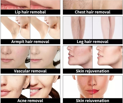 4 In 1 Multifungsi Mesin Kecantikan Mesin Penghapusan Tato Laser Tiga Gelombang