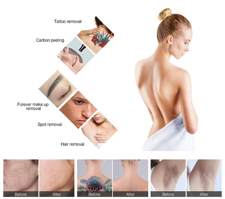 3 In 1 Diode Laser Hair Removal Machine, ND YAG IPL Peralatan Peremajaan Kulit