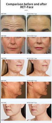 Vertical Magnetic Facial Ems rf Skin Rejuvenation Lifting Skin Tightening Slimming Rf Lifting Mesin untuk mencuci kulit