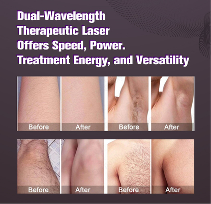 Ukuran besar spot lilin laser alexandrite hair removal rambut putih REMOVAL 2000w alexandrite perangkat laser