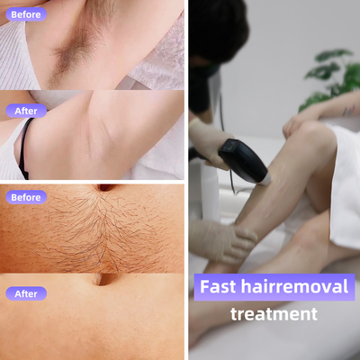 808 Diode Laser Ice Hair Removal Machine 4 panjang gelombang 1064nm Perubahan ukuran titik Sistem Android
